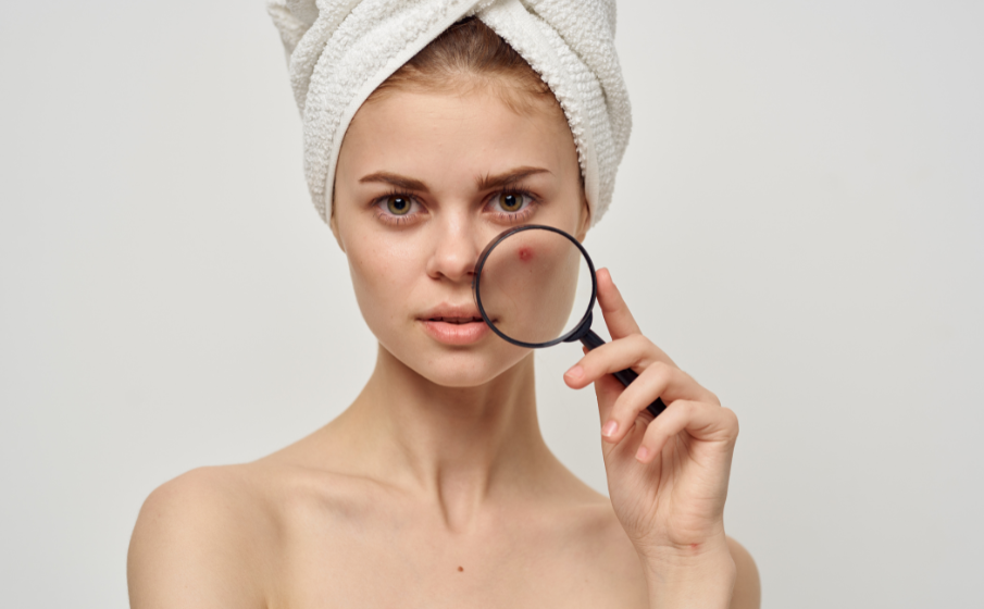 How to Choose Skincare Products for Acne-Prone Skin